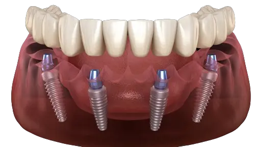 hollywood smile tunisia full Mouth Bridge Dental Implants