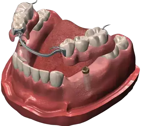 hollywood smile tunisia Implant retained removable prosthesis