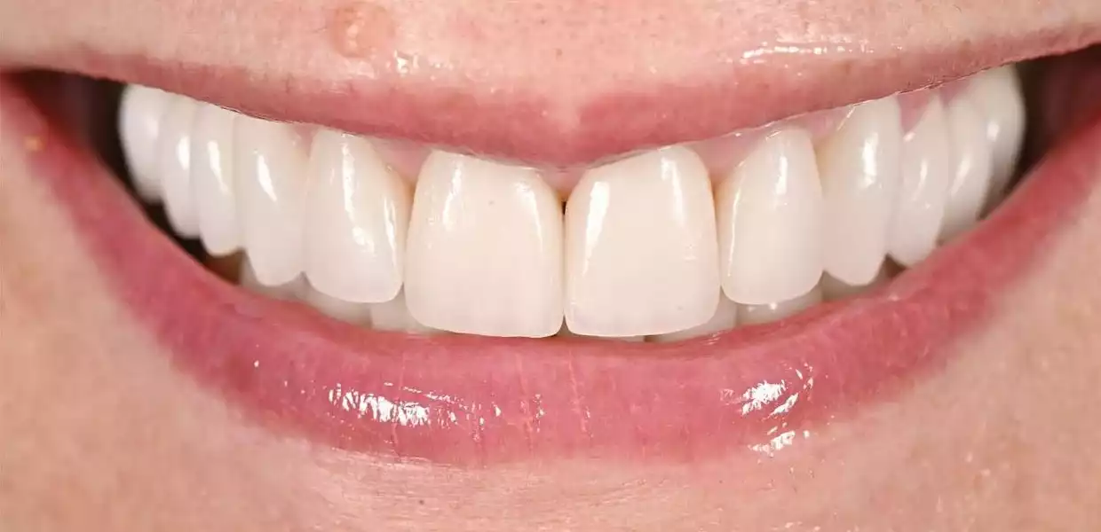 hollywood smile tunisia before after12