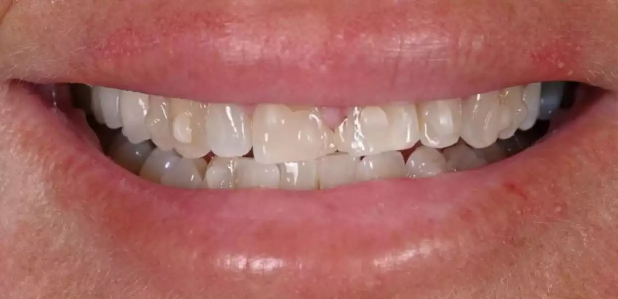 hollywood smile tunisia before after15