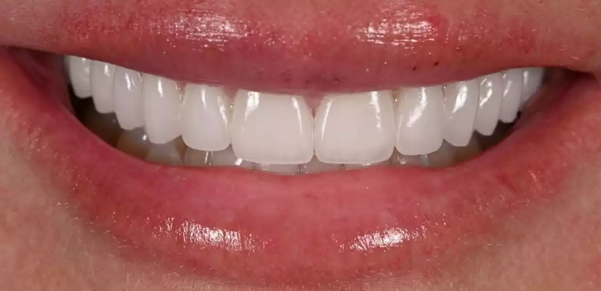 hollywood smile tunisia before after16