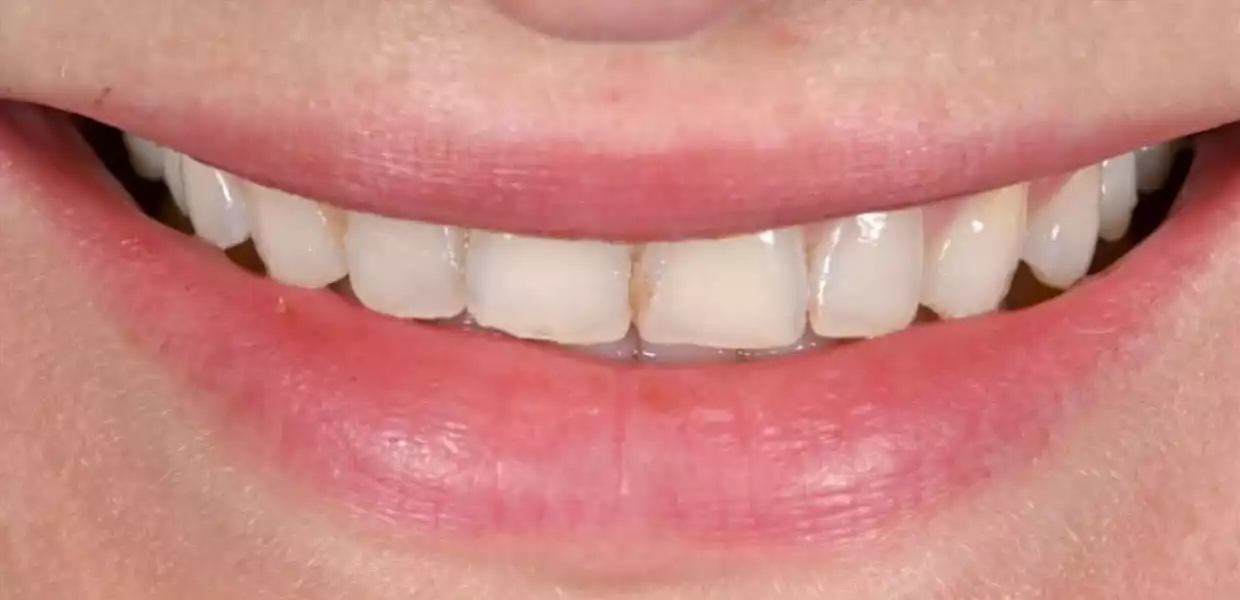 hollywood smile tunisia before after17