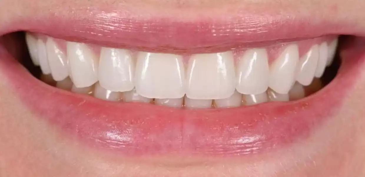 hollywood smile tunisia before after18