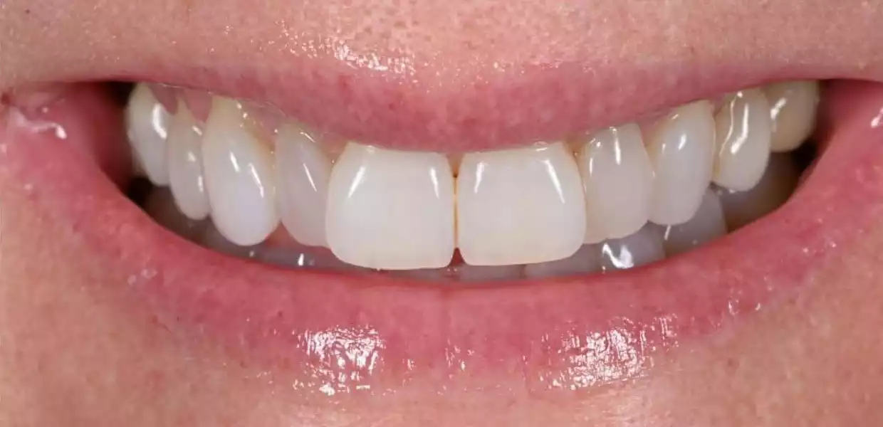 hollywood smile tunisia before after19