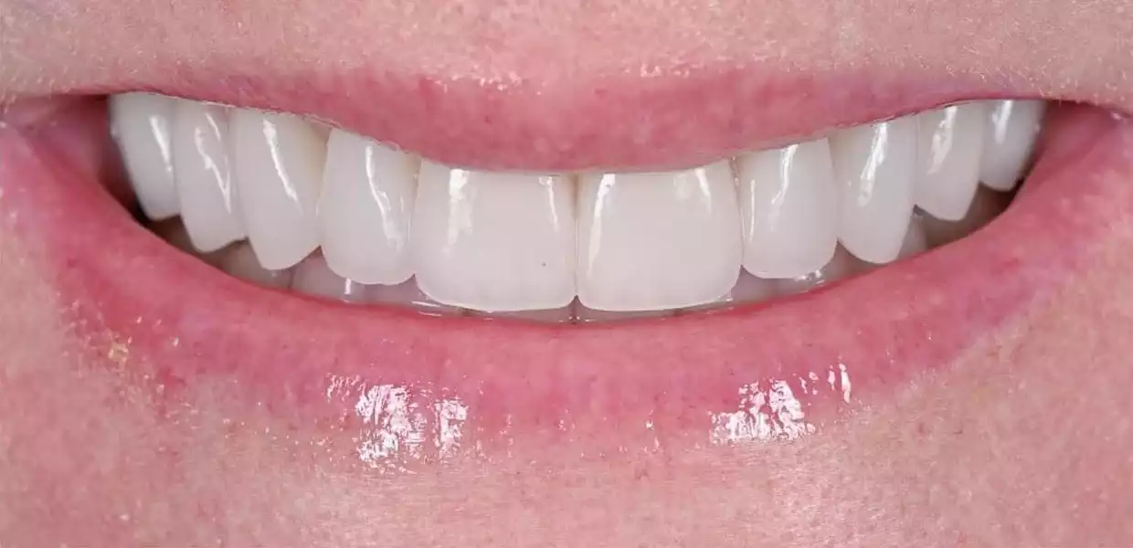 hollywood smile tunisia before after20