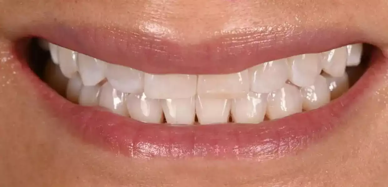 hollywood smile tunisia before after3