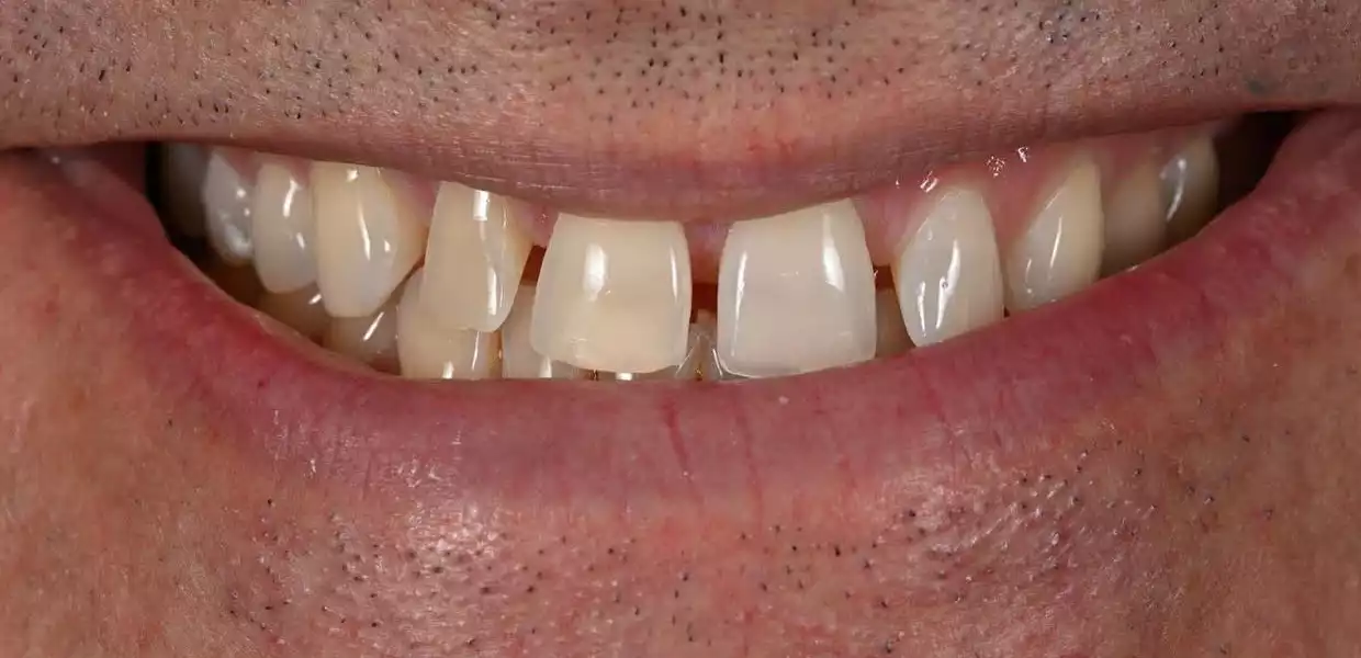 hollywood smile tunisia before after5