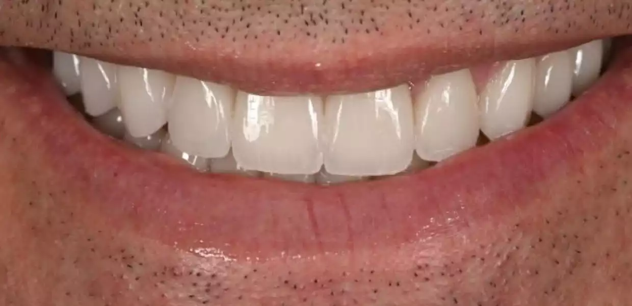 hollywood smile tunisia before after6