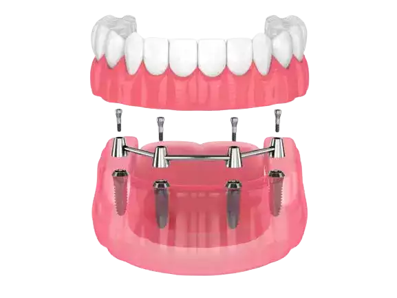 hollywood smile tunisia fixed implant prosthesis